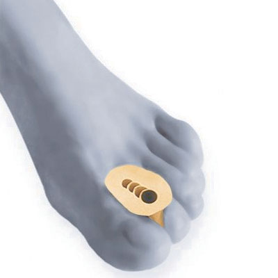 Pernite despartitoare Hallux Valgus Berkemann-8129